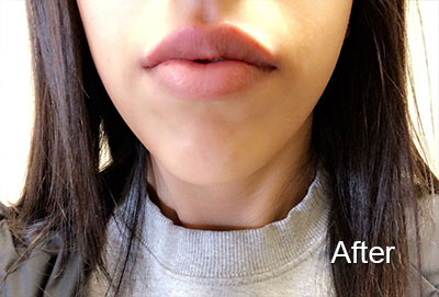 Woman's lips after botox injection
