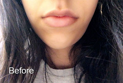 Woman's lips before botox injection